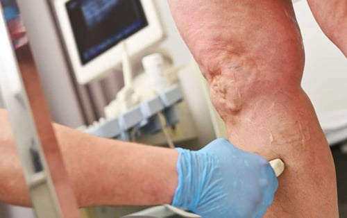 USA Vein Clinics in New Orleans