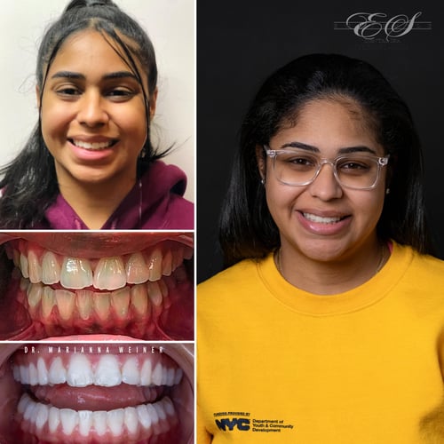 Brooklyn Invisalign Before After  - Hillary Sanchez