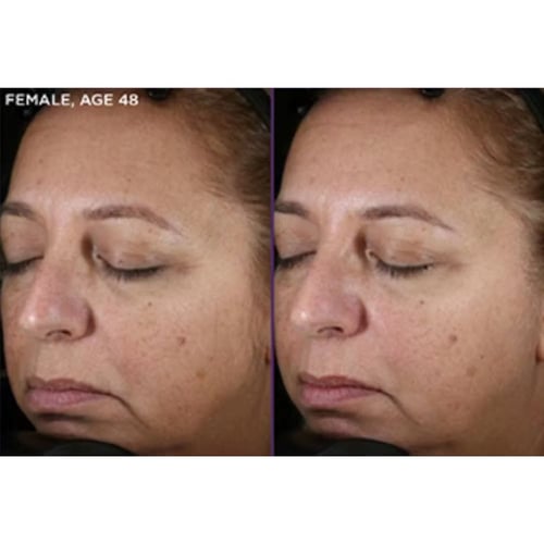 Before and after skin treatments at Genesis Lifestyle Medicine in Hendersonville, TN.
