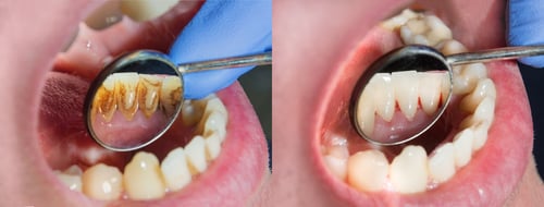Détartrage dentaire à onex et à genève par nos hygiénistes et dentiste