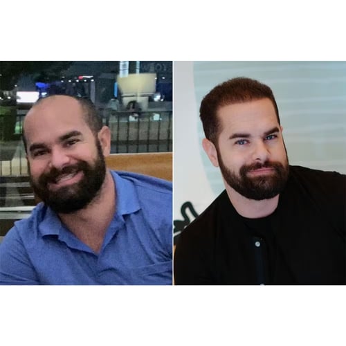 A man before and after getting hair restoration at Genesis Lifestyle Medicine in Las Vegas, NV.