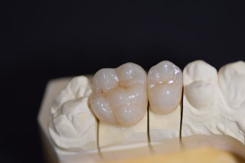 Couronnes monobloc en Zircon translucides