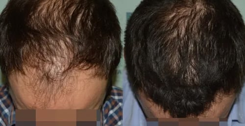 Pure Hair Restoration Center