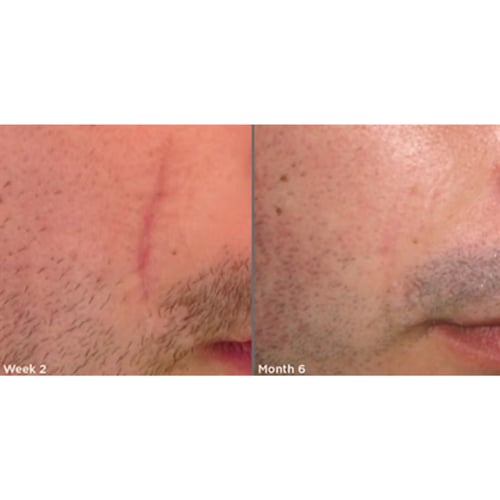 A man's face before and after getting skin treatments at Genesis Lifestyle Medicine in Fort Worth.