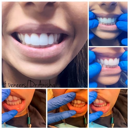 Mile Square Park Family Dental Group - veneers