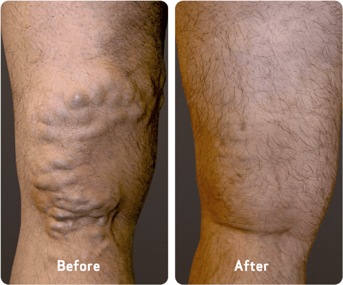 Photo of varicose veins before and after treatment