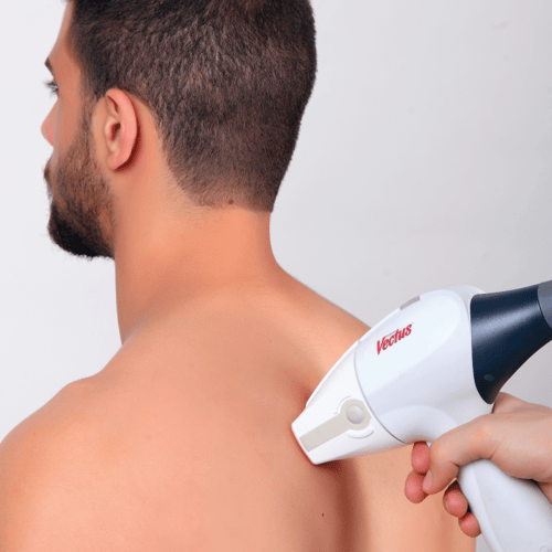 Laser Hair Removal