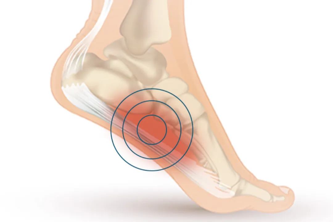illustration of foot with pain in the arch