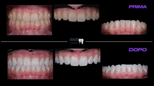 Estetica dentale "sbiancamento"