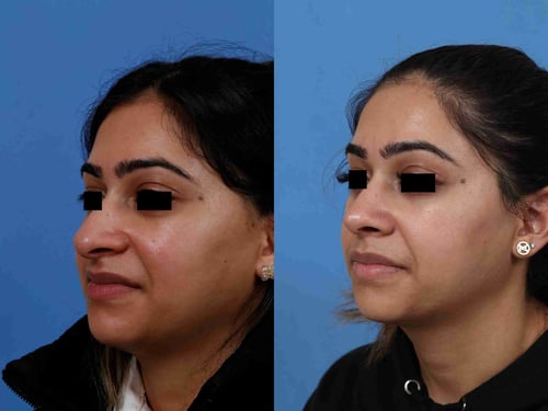 Septorhinoplasty