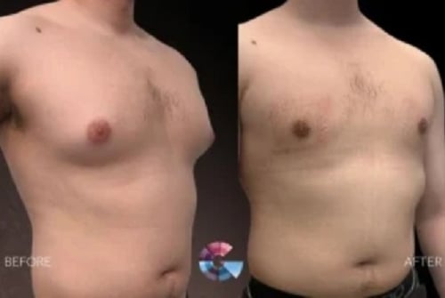 Gynecomastia surgery before-and-after photo – male breast reduction results by Dr. Babak Moein, Los Angeles.