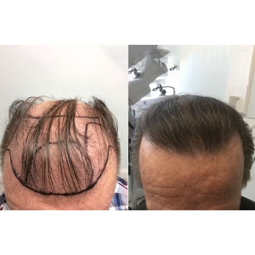Before and after hair restoration in Dallas, at Genesis Lifestyle Medicine.