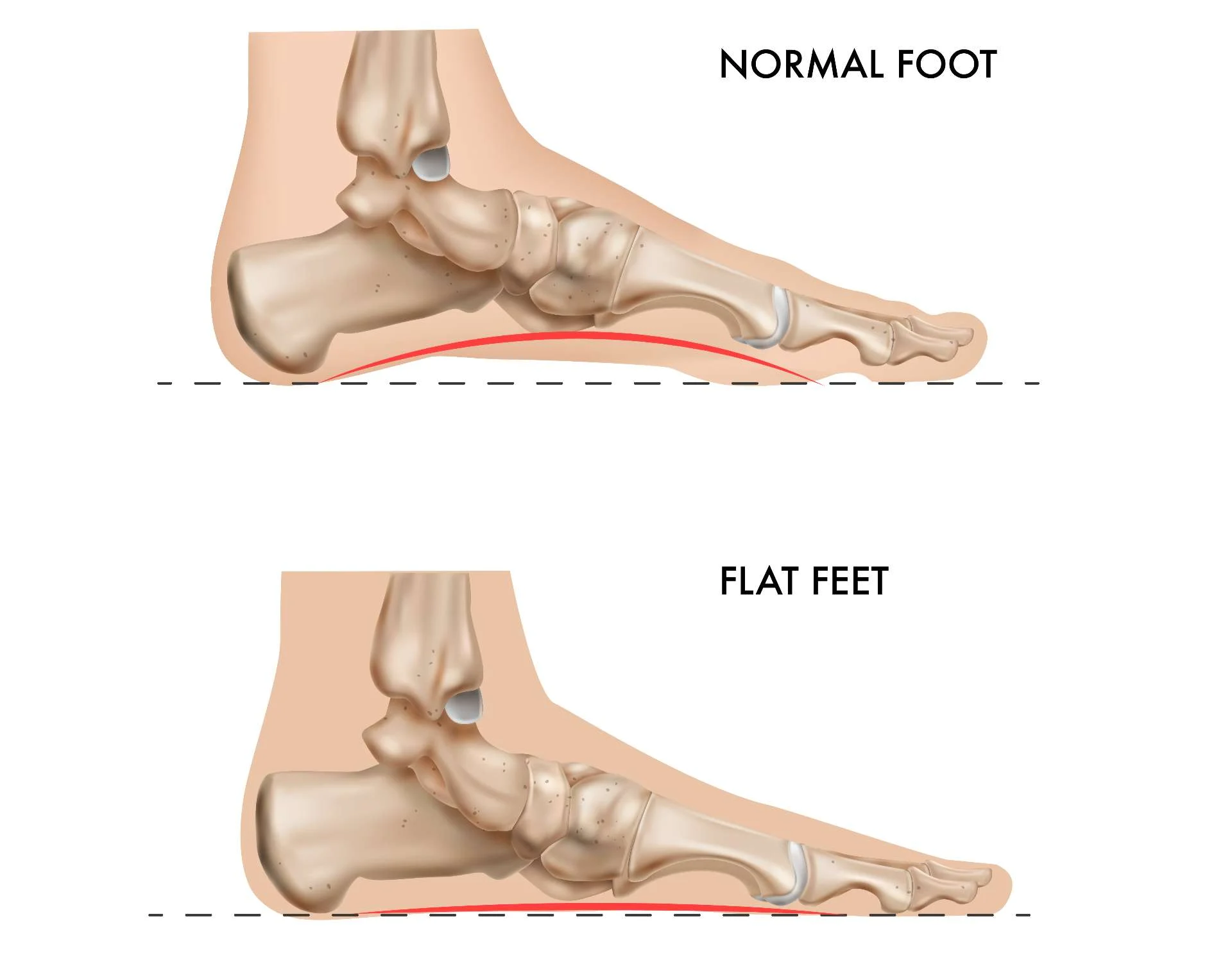 diagram of flat feet versus normal feet