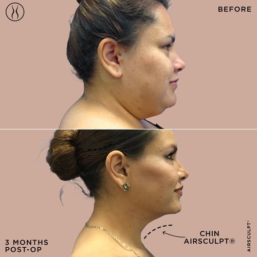 Side Profile view of a Chin AirSculpt Before and After