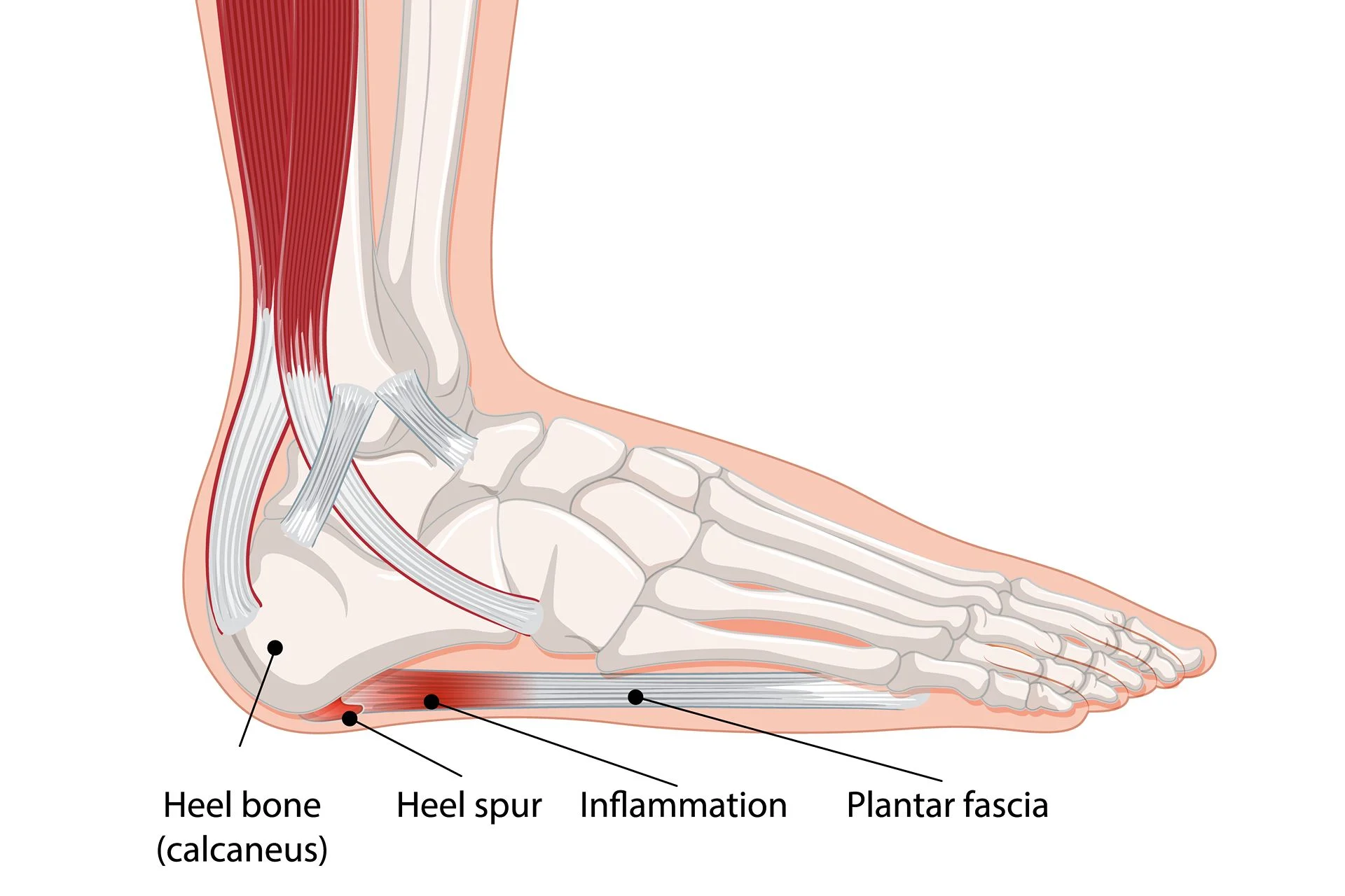 diagram explaining Plantar Fasciitis