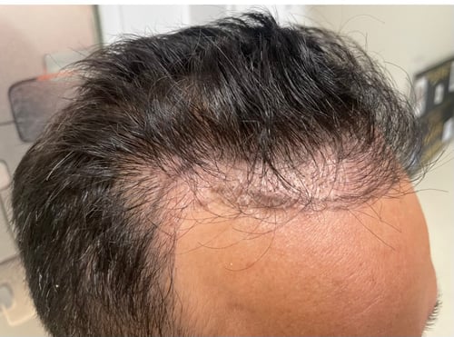 Patient came to Dr Kelemen to see if she can correct his hairline that was done improperly by another doctor.